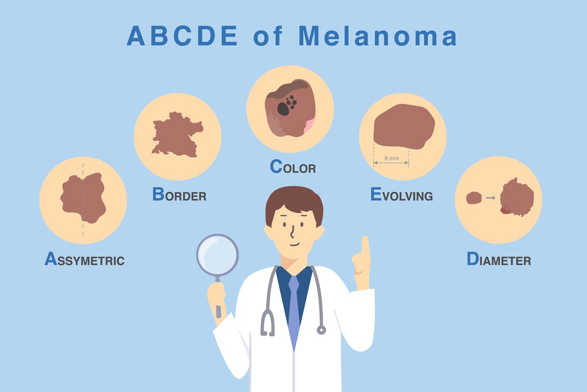 Podozrivé príznaky melanómu podľa ABCDE diagnostiky